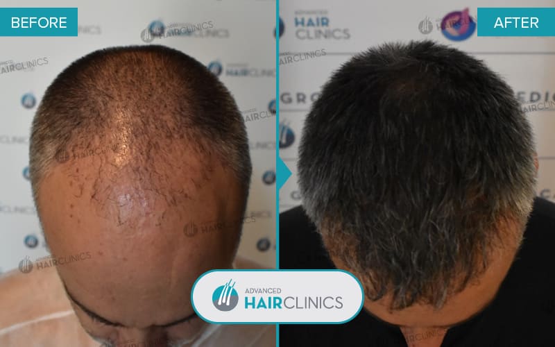 FUE hair transplant with 2.573 hair grafts. Before and after treatment. Result 069.