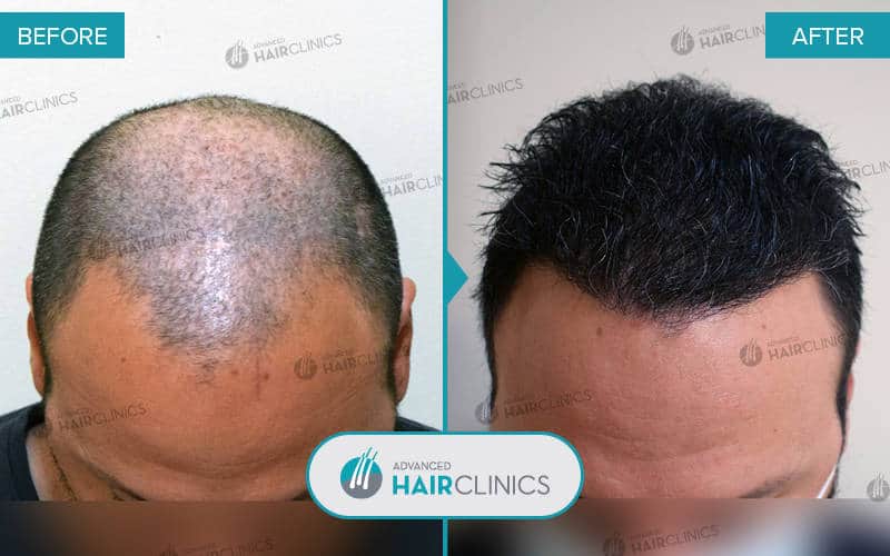 FUE hair transplant with 4.145 hair grafts. Before and after treatment. Result 070.