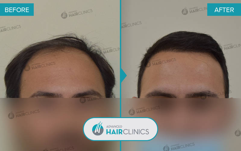 FUE hair transplant with 4.009 hair grafts. Before and after treatment. Result 071.
