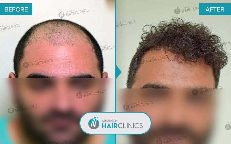FUE hair transplant with 3.807 hair grafts. Before and after treatment. Result 072.