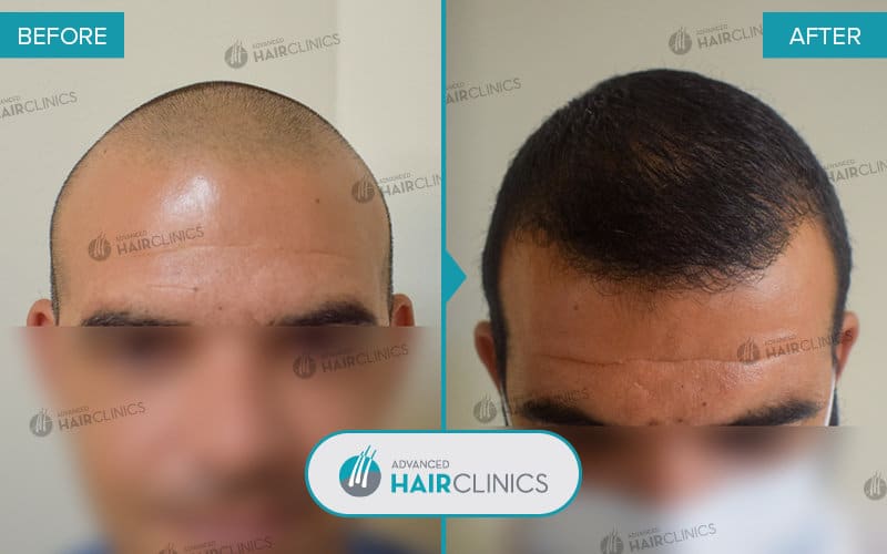 FUE hair transplant with 2.029 hair grafts. Before and after treatment. Result 073.