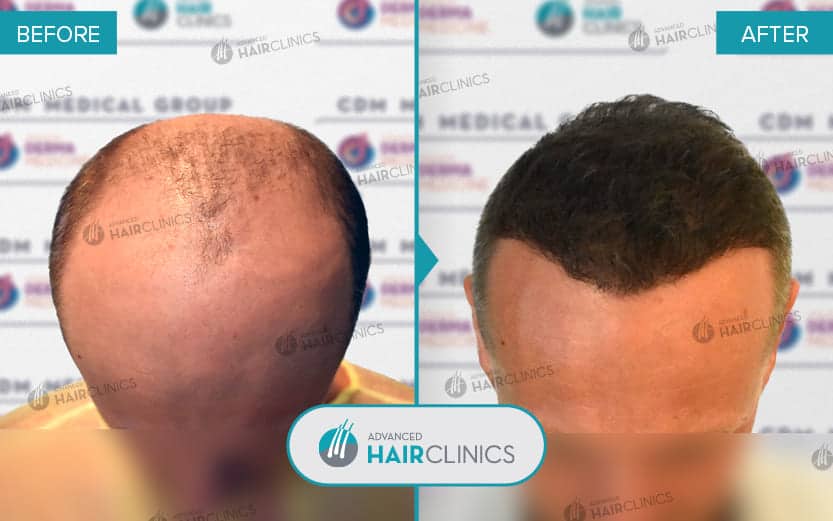 FUE hair transplant with 5.120 hair grafts. Before and after treatment. Result 074.