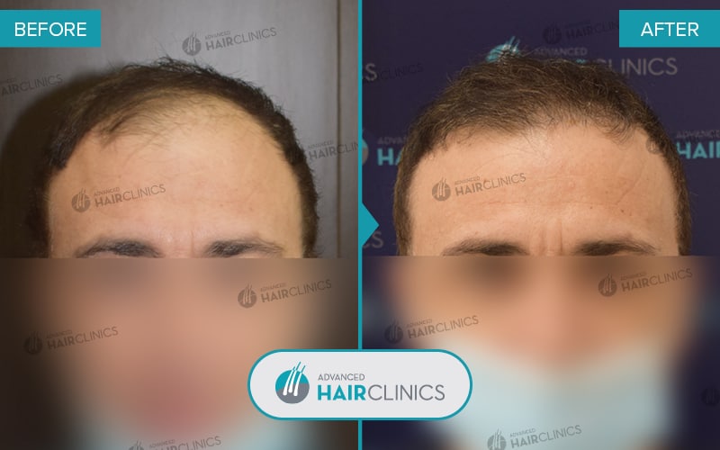 FUE hair transplant with 1.658 hair grafts. Before and after treatment. Result 075.