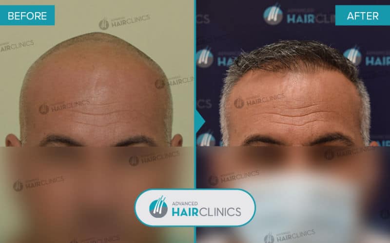 FUE hair transplant with 2.244 hair grafts. Before and after treatment. Result 076.