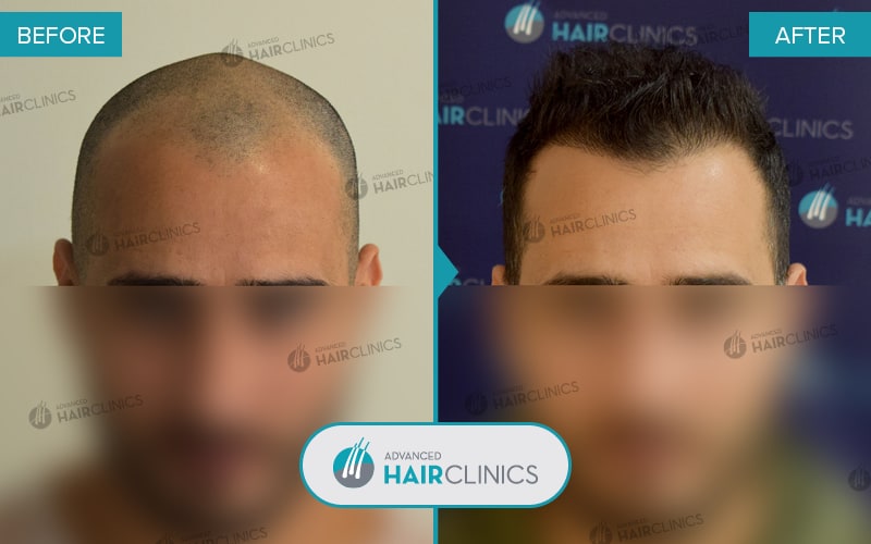 FUE hair transplant with 1.788 hair grafts. Before and after treatment. Result 080.