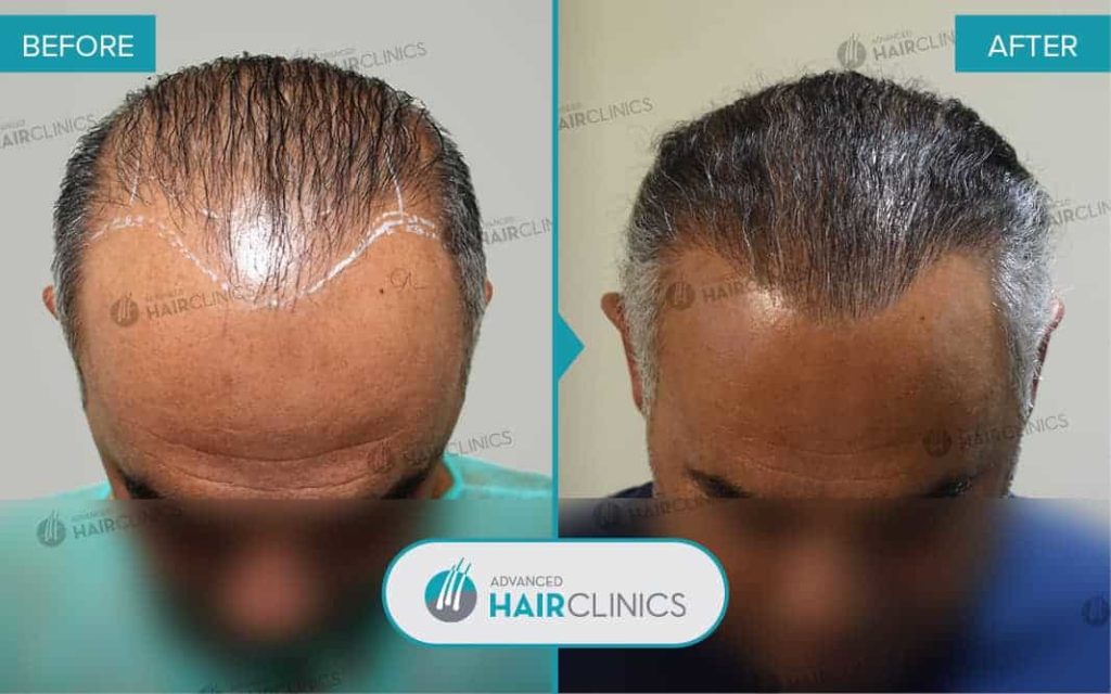 FUE hair transplant with 2.131 hair grafts. Before and after treatment. Result 083.