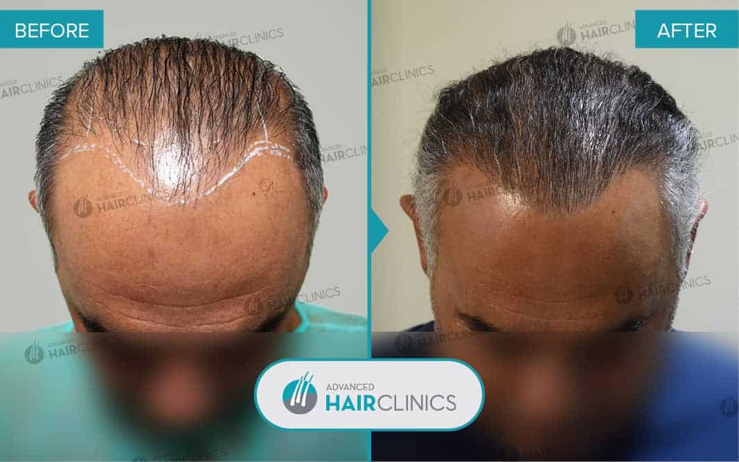 FUE hair transplant with 2.131 hair grafts. Before and after treatment. Result 083.