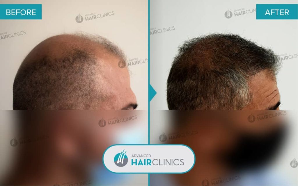 FUE hair transplant with 3.577 hair grafts. Before and after treatment. Result 084.