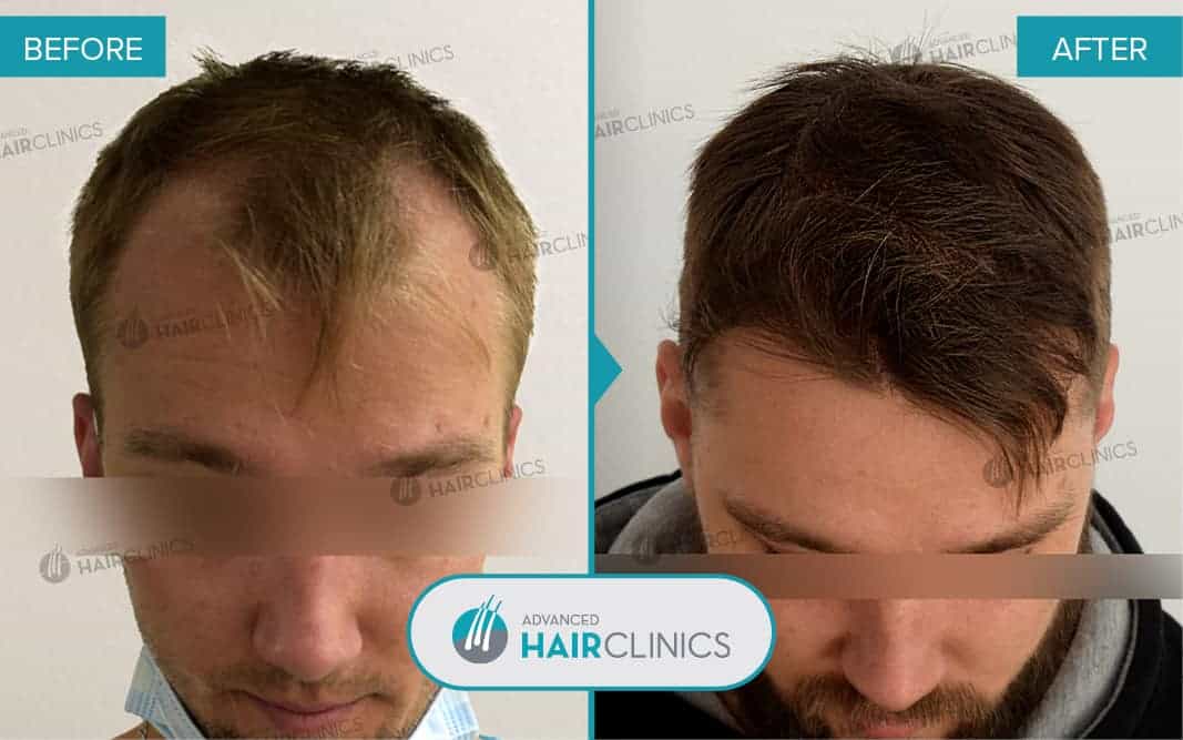 FUE hair transplant with 3.195 hair grafts. Before and after treatment. Result 086.