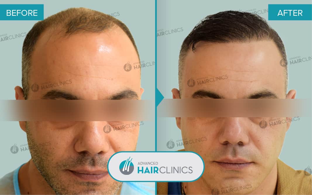FUE hair transplant with 3.695 hair grafts. Before and after treatment. Result 087.