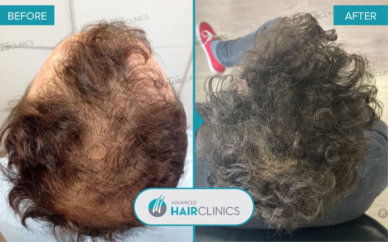 FUE hair transplant with 2.307 hair grafts. Before and after treatment. Result 088.