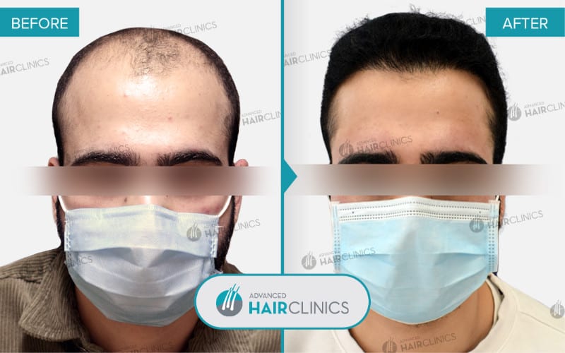 FUE hair transplant with 2.293 hair grafts. Before and after treatment. Result 091.