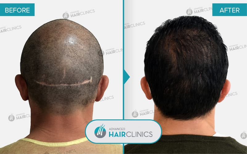 FUE hair transplant with 3.965 hair grafts. Before and after treatment. Result 092.