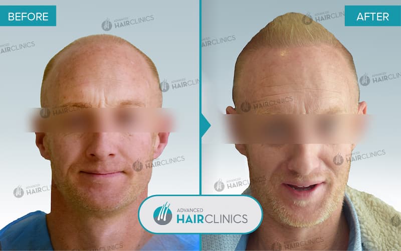 FUE hair transplant with 3.476 hair grafts. Before and after treatment. Result 096.