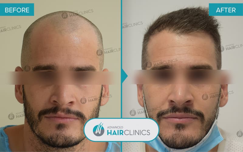 FUE hair transplant with 3.931 hair grafts. Before and after treatment. Result 098.
