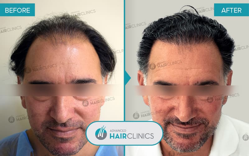 FUE hair transplant with 4.226 hair grafts. Before and after treatment. Result 099.