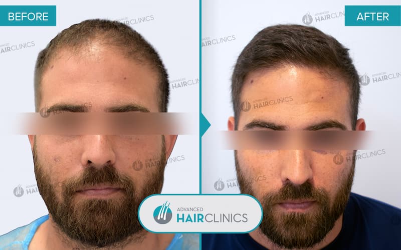 FUE hair transplant with 2.396 hair grafts. Before and after treatment. Result 100.