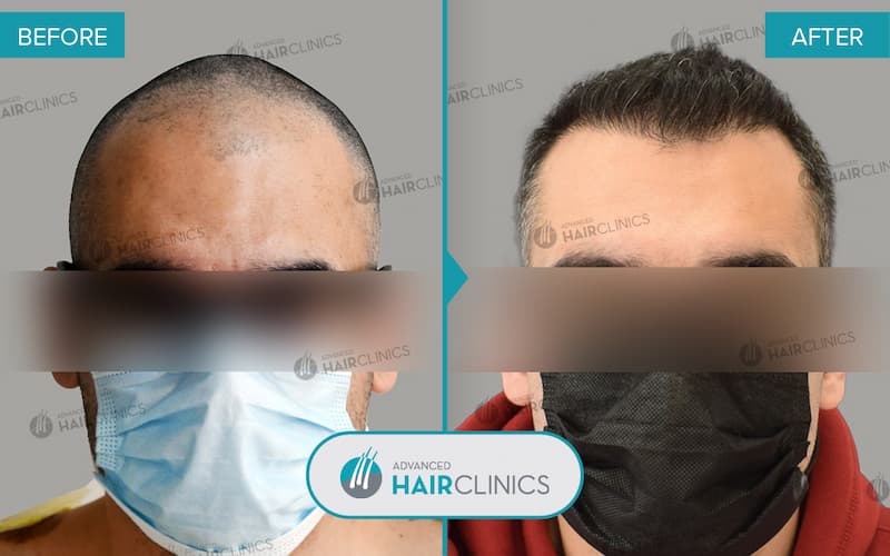 FUE hair transplant with 2.020 hair grafts. Before and after treatment. Result 101.