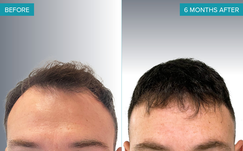 Greffe de cheveux FUE avec 2.304 follicules. Avant et apr&egrave;s le traitement. R&eacute;sultat 125.