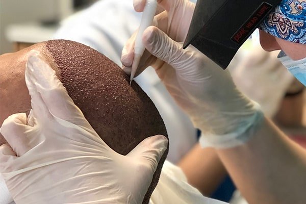 Μεταμόσχευση μαλλιών fue σε ασθενή με γυροειδή αλωπεκία.