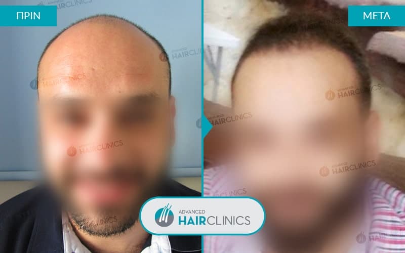 &Mu;&epsilon;&tau;&alpha;&mu;ό&sigma;&chi;&epsilon;&upsilon;&sigma;&eta; &mu;&alpha;&lambda;&lambda;&iota;ώ&nu; FUE &mu;&epsilon; 4.639 &tau;&rho;&iota;&chi;&omicron;&theta;&upsilon;&lambda;ά&kappa;&iota;&alpha;, &pi;&rho;&iota;&nu; &kappa;&alpha;&iota; &mu;&epsilon;&tau;ά &tau;&eta;&nu; &theta;&epsilon;&rho;&alpha;&pi;&epsilon;ί&alpha;. &Alpha;&pi;&omicron;&tau;έ&lambda;&epsilon;&sigma;&mu;&alpha; 015.