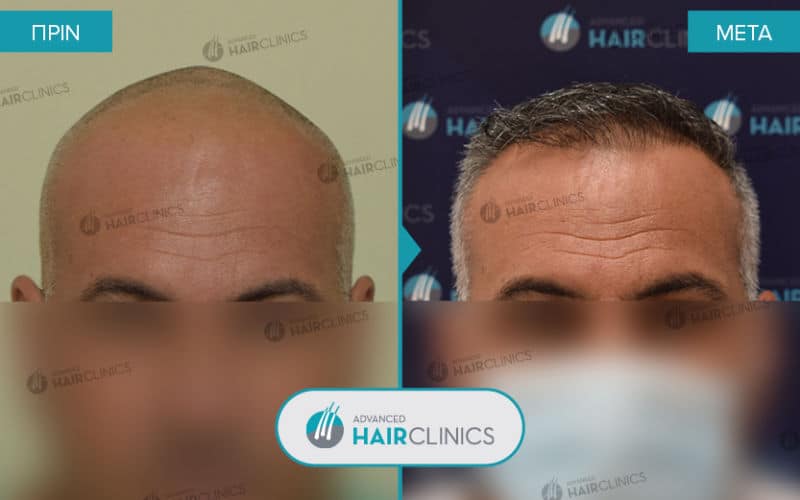&Mu;&epsilon;&tau;&alpha;&mu;ό&sigma;&chi;&epsilon;&upsilon;&sigma;&eta; &mu;&alpha;&lambda;&lambda;&iota;ώ&nu; FUE &mu;&epsilon; 2.244 &tau;&rho;&iota;&chi;&omicron;&theta;&upsilon;&lambda;ά&kappa;&iota;&alpha;, &pi;&rho;&iota;&nu; &kappa;&alpha;&iota; &mu;&epsilon;&tau;ά &tau;&eta;&nu; &theta;&epsilon;&rho;&alpha;&pi;&epsilon;ί&alpha;. &Alpha;&pi;&omicron;&tau;έ&lambda;&epsilon;&sigma;&mu;&alpha; 076.