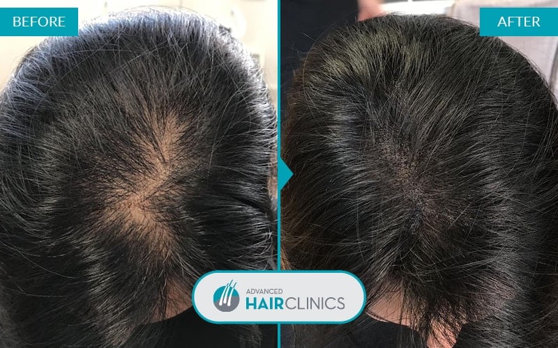Scalp Micropigmentation after 1 session. Before and after treatment. Result 001.