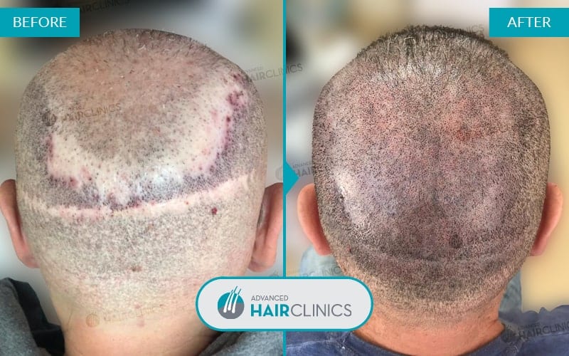 Scalp Micropigmentation after 1 session. Before and after treatment. Result 003.