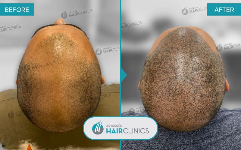 Scalp Micropigmentation after 2 sessions. Before and after treatment. Result 004.