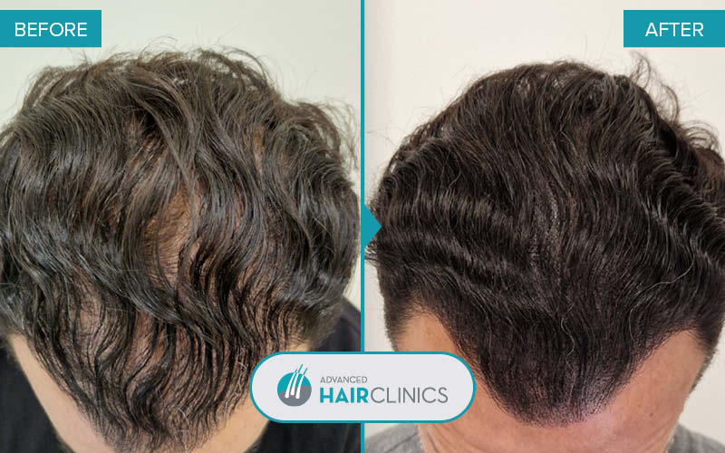 Scalp Micropigmentation after 3 session. Before and after treatment. Result 007.