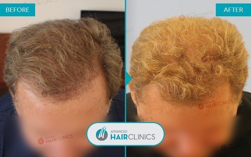 Unshaven FUE hair transplant with 3.427 hair grafts. Before and after treatment, front. Result 002.