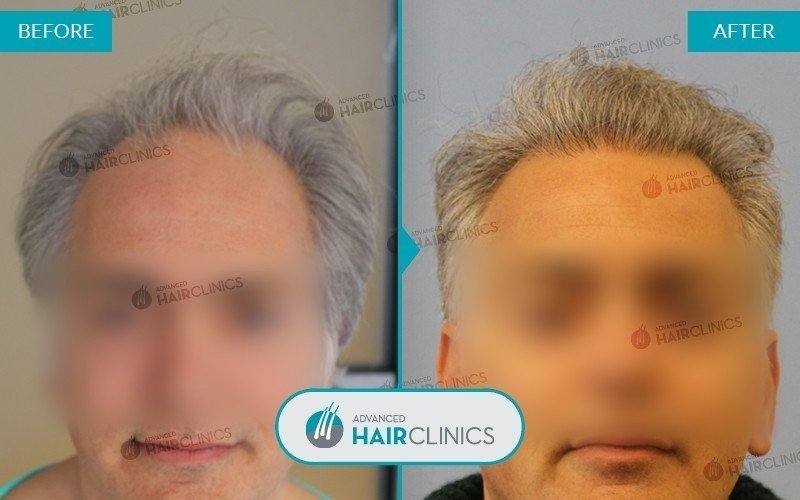 Unshaven FUE hair transplant with 1.244 hair grafts. Before and after treatment, front. Result 003.